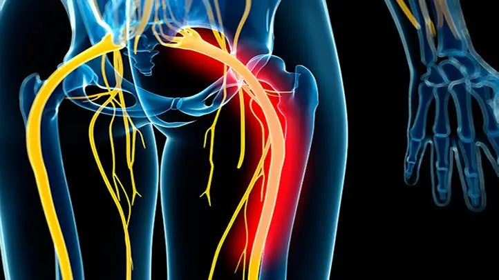 Soulager sciatique : guérir et réduire la douleur du nerf