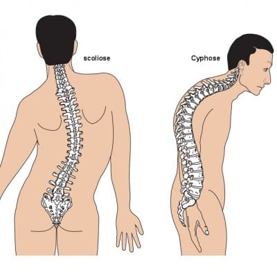 personne atteinte de cyphose et scoliose
