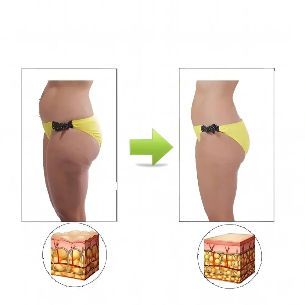Rouleau de massage acupression -Élimination de la cellulite