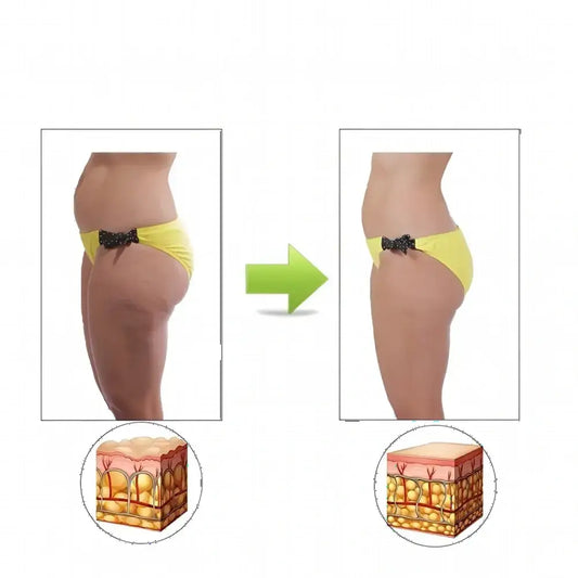 Rouleau de massage acupression -Élimination de la cellulite