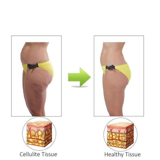 Rouleau de massage acupression -Élimination de la cellulite